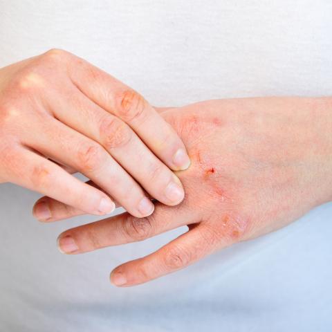 Winter Skin Causes Patrick Hatfield Md Dermatology Batesville Arkansas