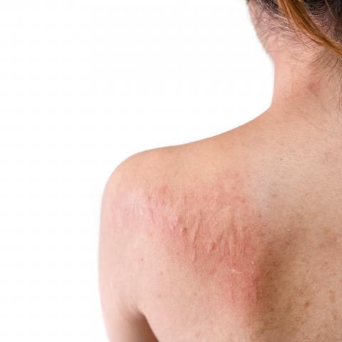 photos of skin rashes