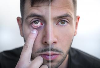 Left side of man's face unhealthy, right side of man's face healthy.